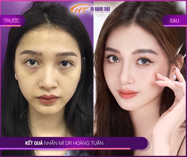 Kết quả bấm mí tại Thẩm mỹ Hoàng Tuấn